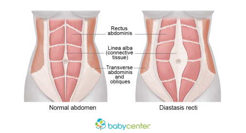 505x273xbc-diastasis-recti-logo_wide.png.pagespeed.ic.Bs0WyqwA6t.png